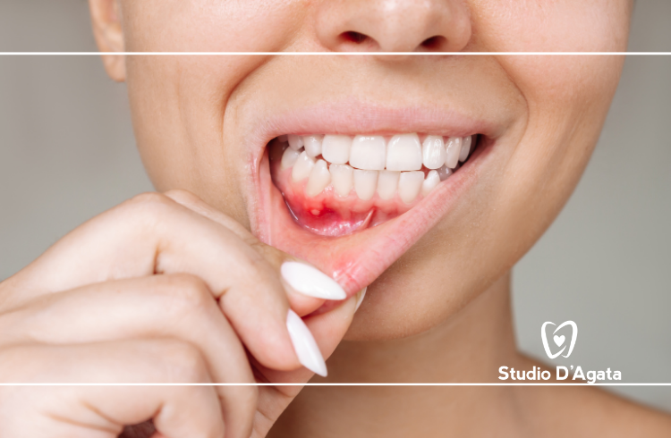 Parodontite: la malattia che fa cadere i denti senza fare male
